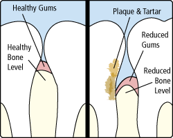 Periodontitis